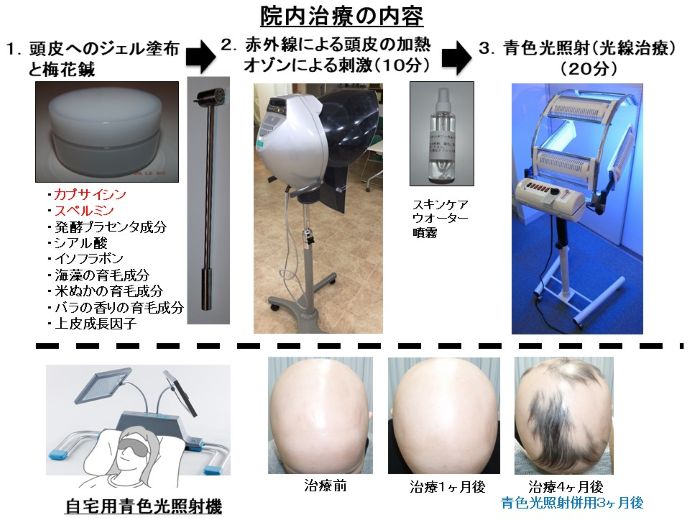 円形脱毛症　病院